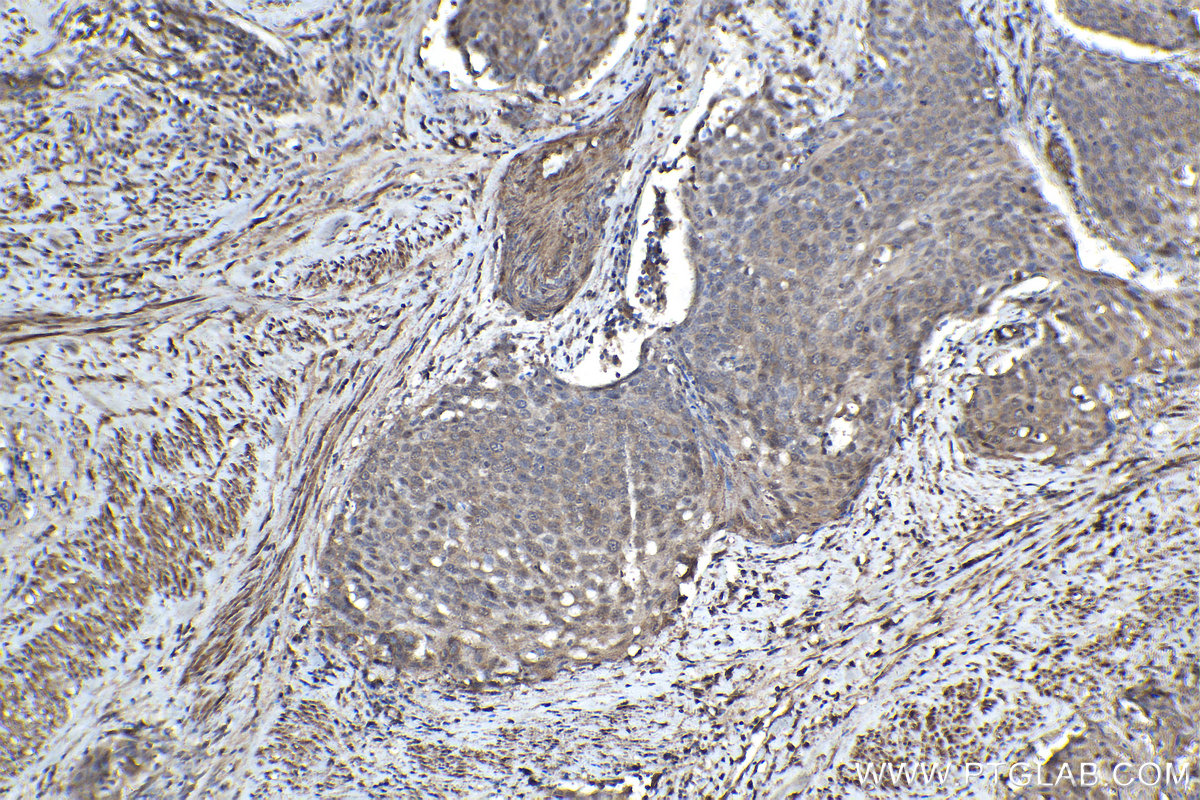 Immunohistochemical analysis of paraffin-embedded human cervical cancer tissue slide using KHC2106 (ROCK2 IHC Kit).