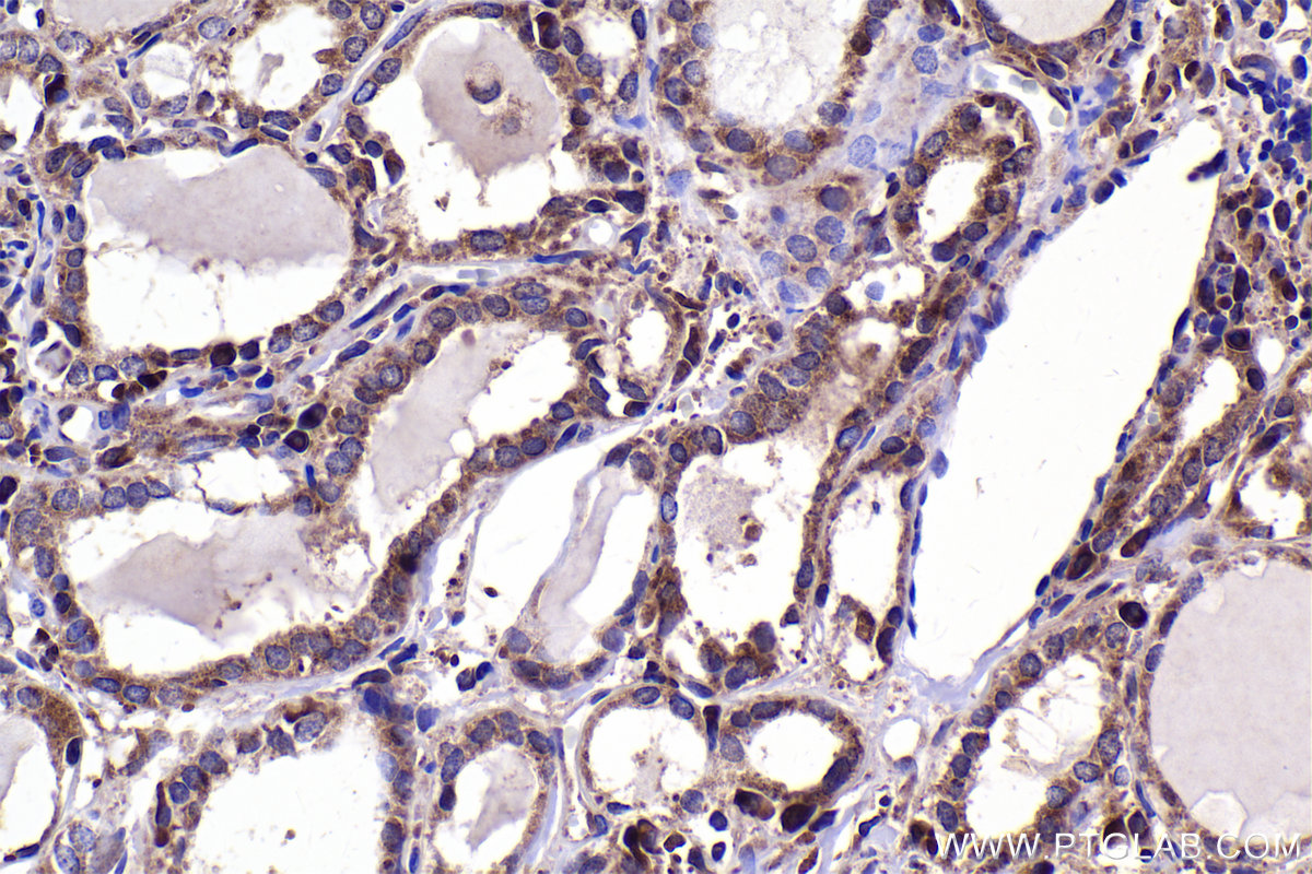 Immunohistochemical analysis of paraffin-embedded human thyroid cancer tissue slide using KHC2354 (RPL11 IHC Kit).