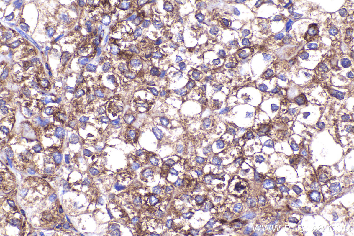 Immunohistochemical analysis of paraffin-embedded human endometrial cancer tissue slide using KHC2225 (RPL12 IHC Kit).