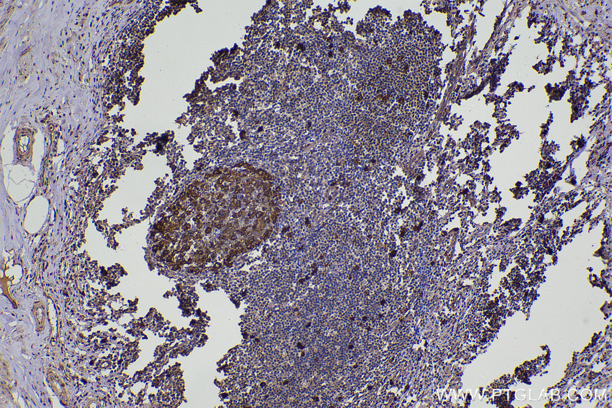 Immunohistochemical analysis of paraffin-embedded human appendicitis tissue slide using KHC2233 (RRM2 IHC Kit).