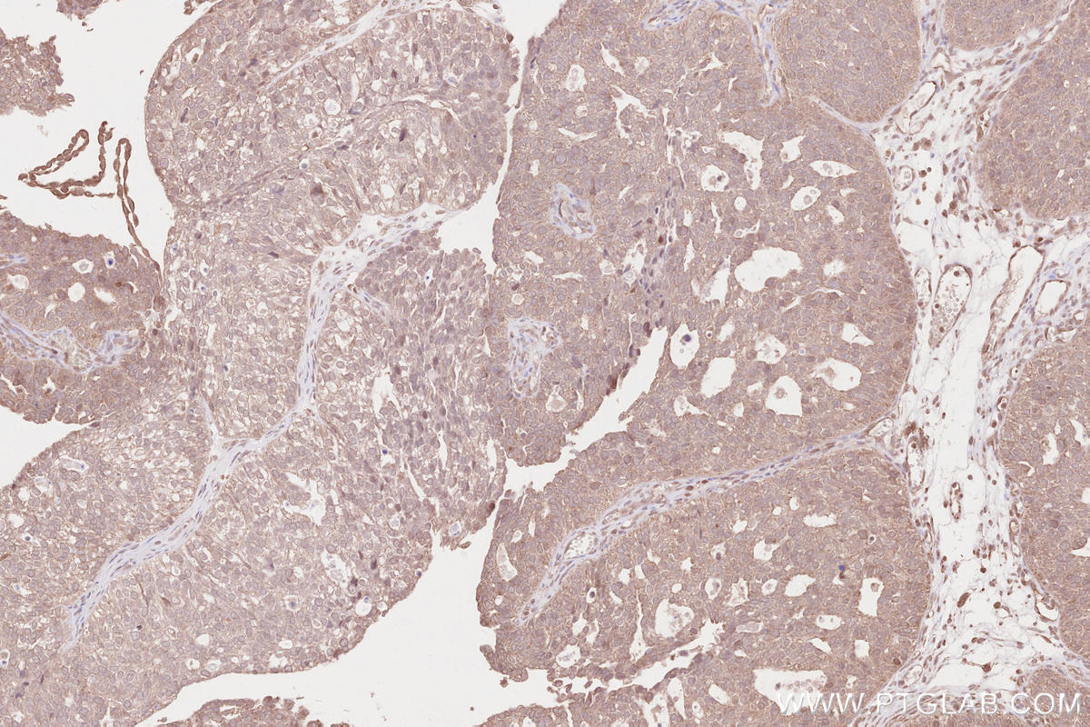 Immunohistochemical analysis of paraffin-embedded human ovary cancer tissue slide using KHC2630 (SDCCAG8 IHC Kit).