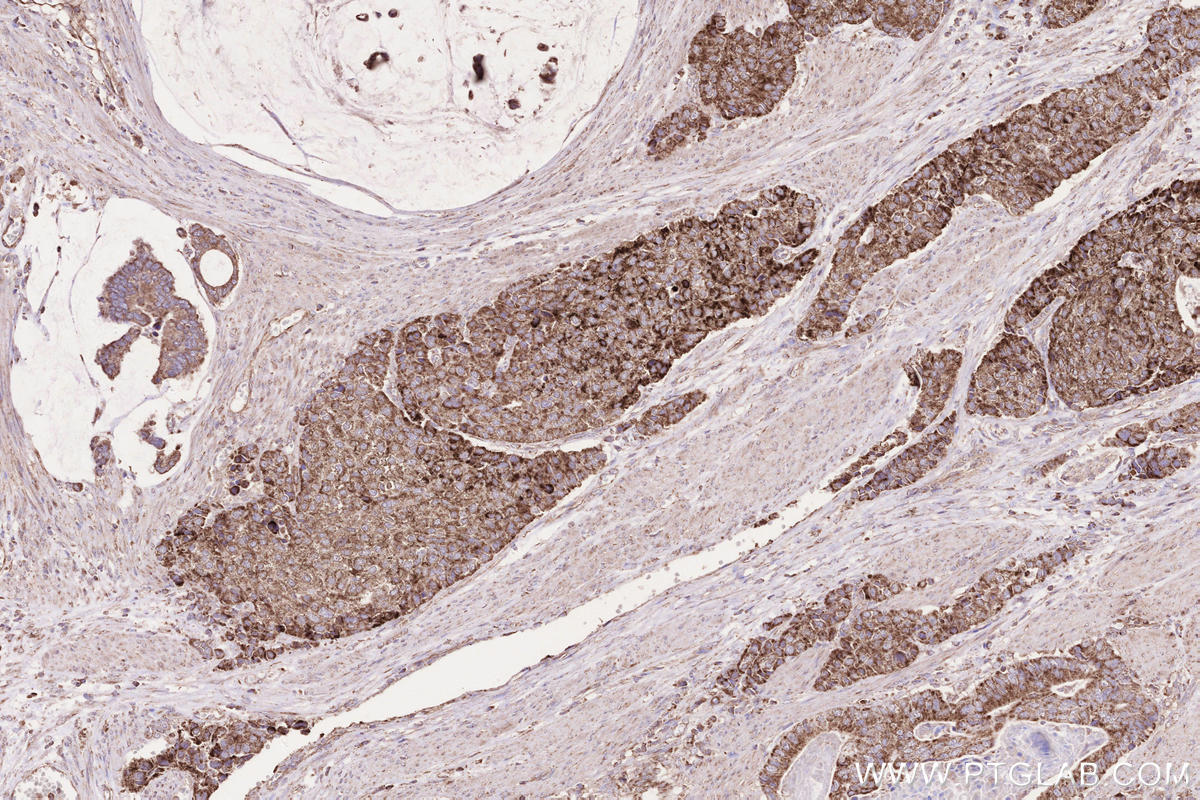 Immunohistochemical analysis of paraffin-embedded human stomach cancer tissue slide using KHC2509 (SDHB IHC Kit).