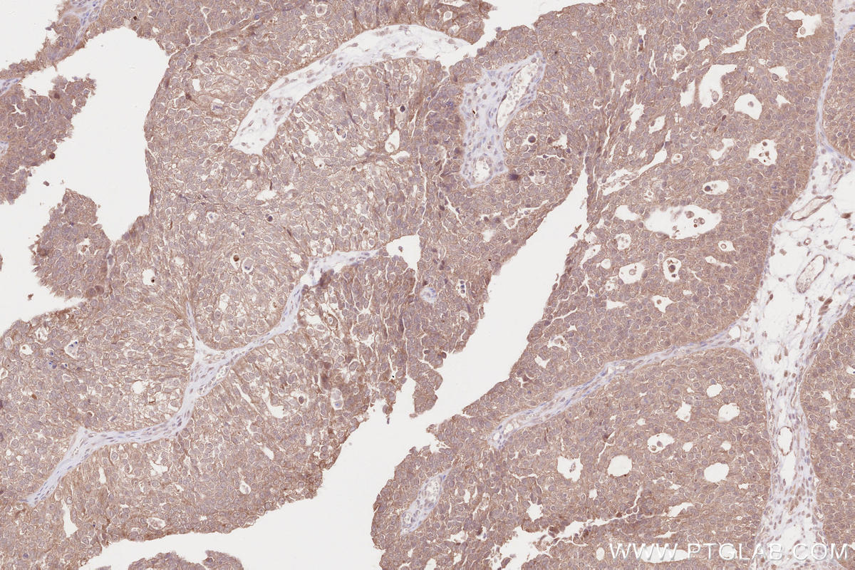 Immunohistochemical analysis of paraffin-embedded human ovary cancer tissue slide using KHC2606 (SEPT14 IHC Kit).