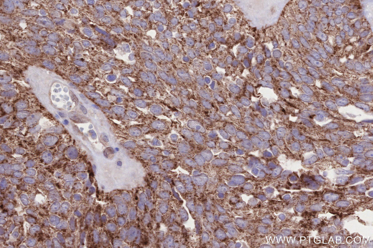 Immunohistochemical analysis of paraffin-embedded human ovary cancer tissue slide using KHC2643 (SIAH1 IHC Kit).