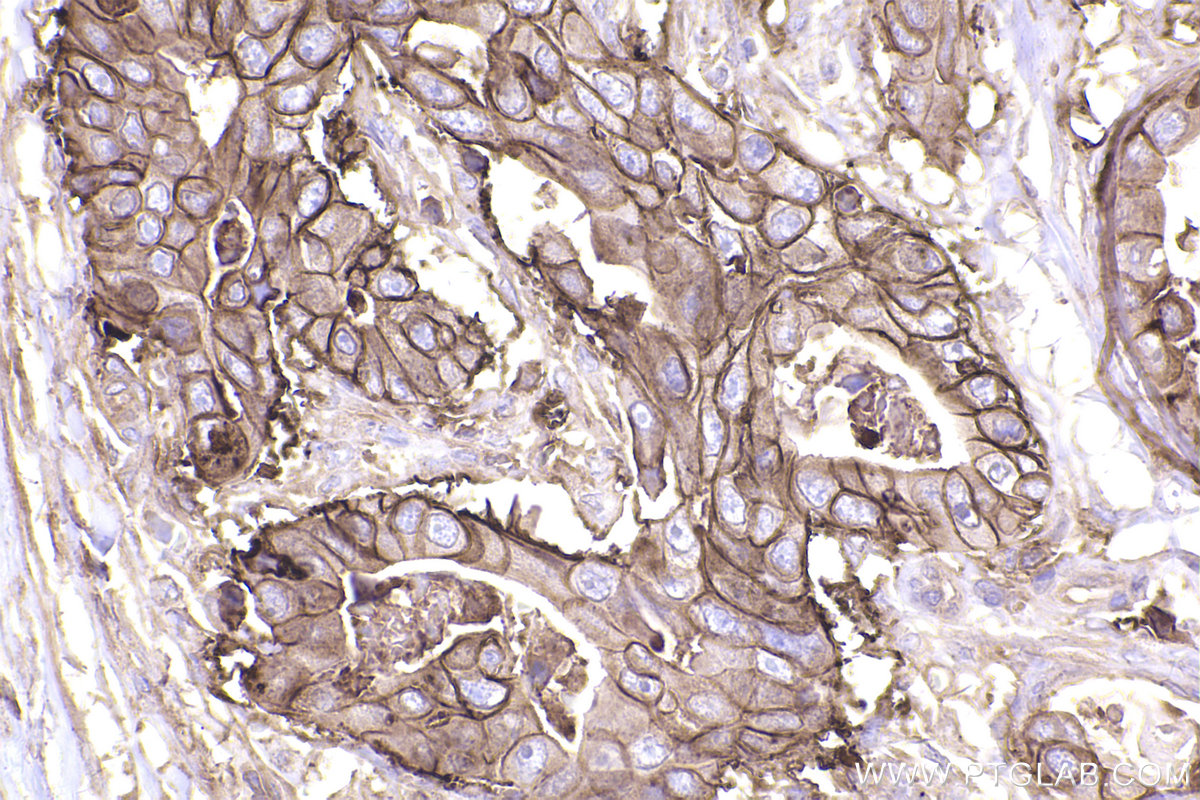 Immunohistochemical analysis of paraffin-embedded human stomach cancer tissue slide using KHC2497 (SLC1A5/ASCT2 IHC Kit).