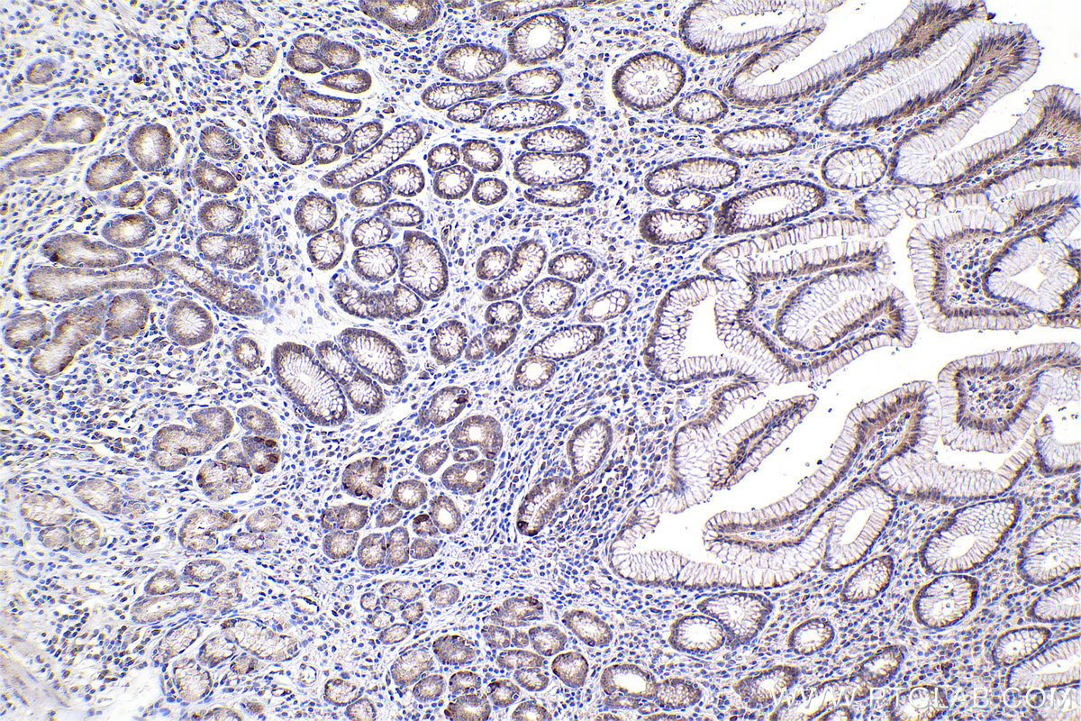 Immunohistochemical analysis of paraffin-embedded human stomach cancer tissue slide using KHC2372 (SMAD3 IHC Kit).