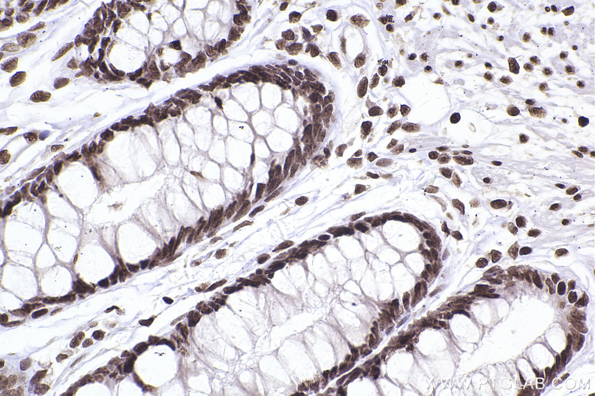 Immunohistochemical analysis of paraffin-embedded human rectal cancer tissue slide using KHC2465 (SMC1A IHC Kit).