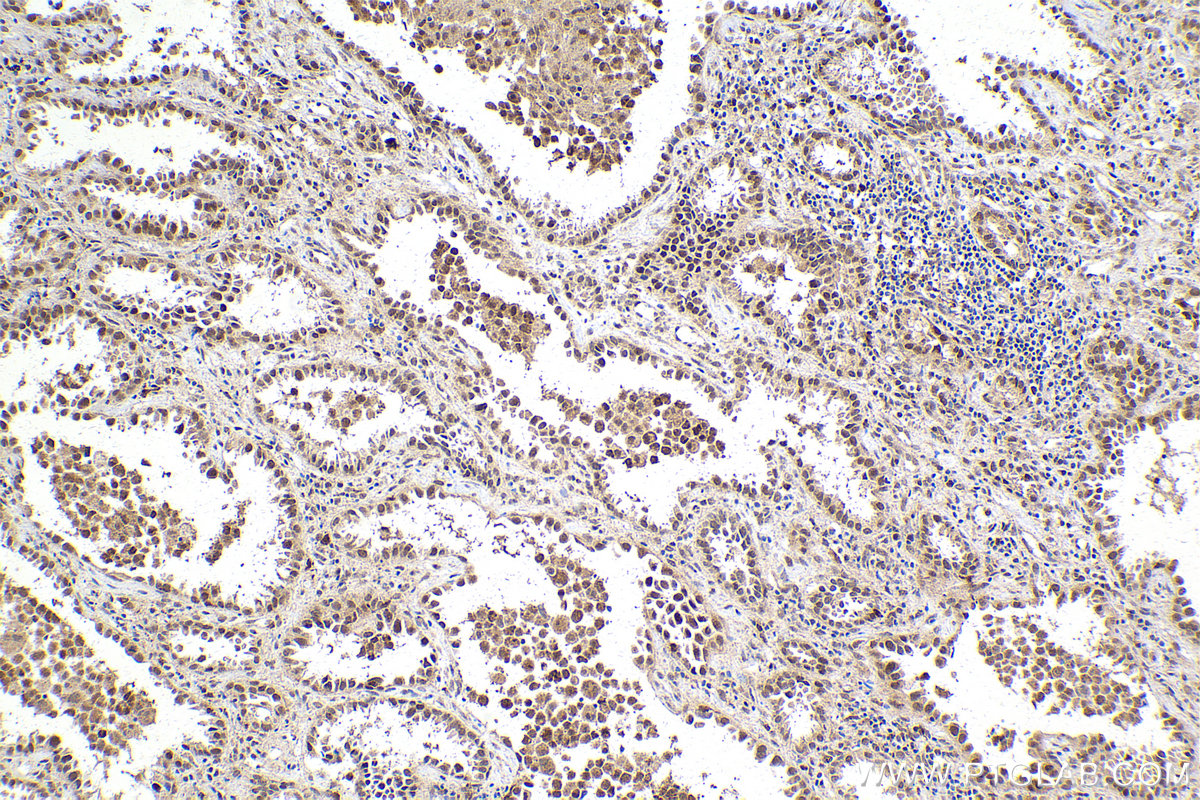 Immunohistochemical analysis of paraffin-embedded human lung cancer tissue slide using KHC2143 (SMC2 IHC Kit).