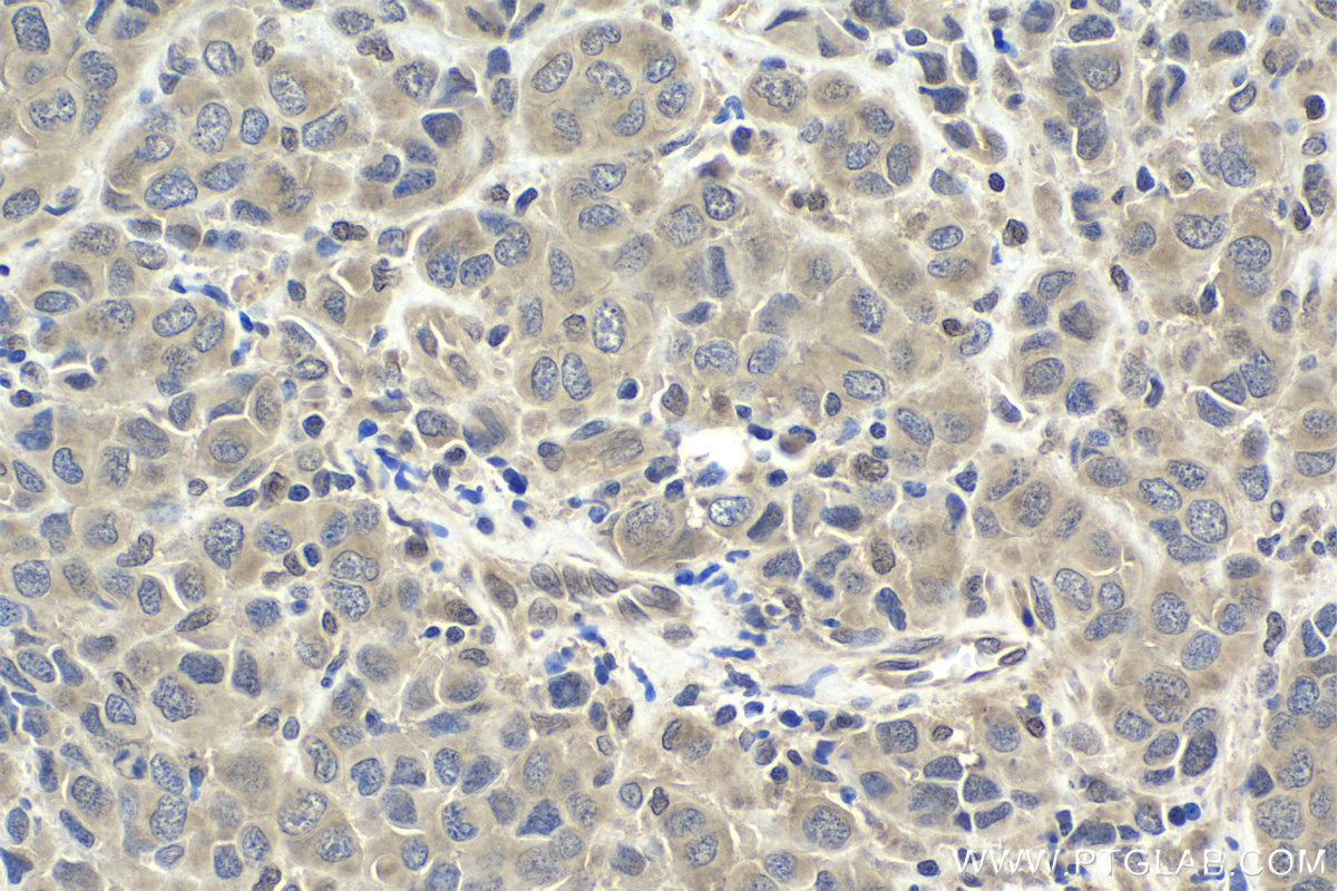 Immunohistochemical analysis of paraffin-embedded human malignant melanoma tissue slide using KHC1941 (SMURF2 IHC Kit).