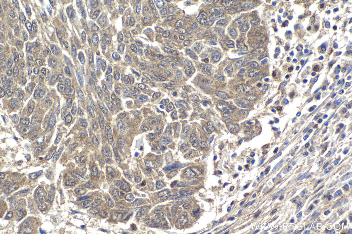 Immunohistochemical analysis of paraffin-embedded human lung cancer tissue slide using KHC1941 (SMURF2 IHC Kit).
