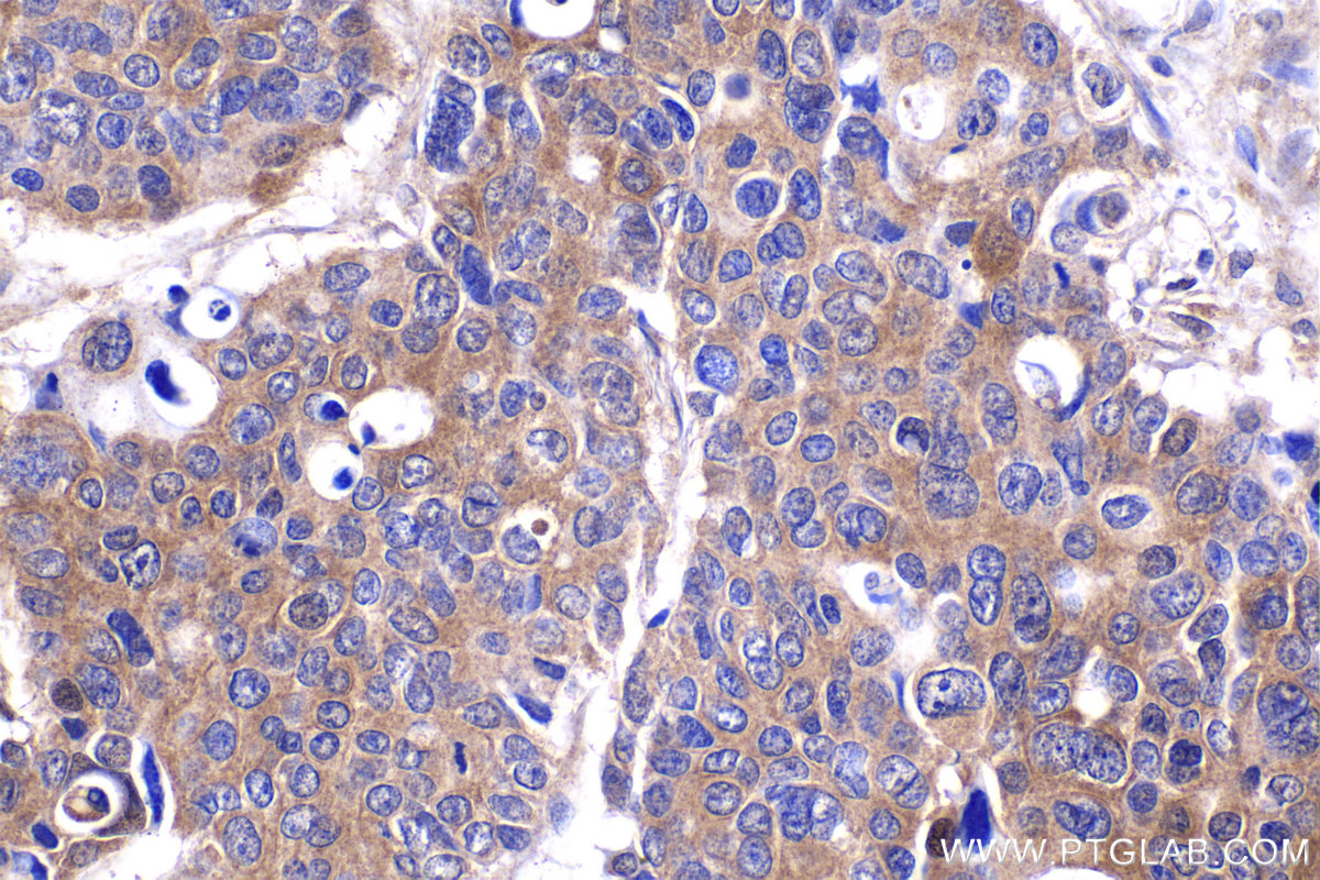 Immunohistochemical analysis of paraffin-embedded human stomach cancer tissue slide using KHC2335 (SNAP25 IHC Kit).