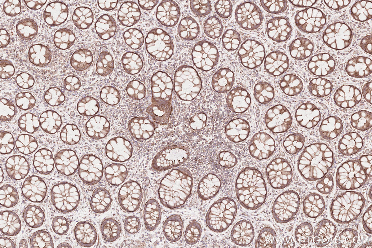 Immunohistochemical analysis of paraffin-embedded human rectal cancer tissue slide using KHC2574 (SPECC1L/CYTSA IHC Kit).