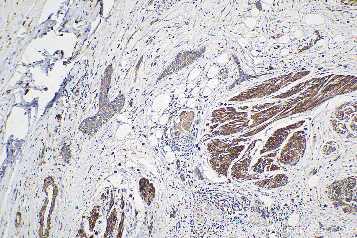 Immunohistochemical analysis of paraffin-embedded human urothelial carcinoma tissue slide using KHC2105 (SRGAP2 IHC Kit).