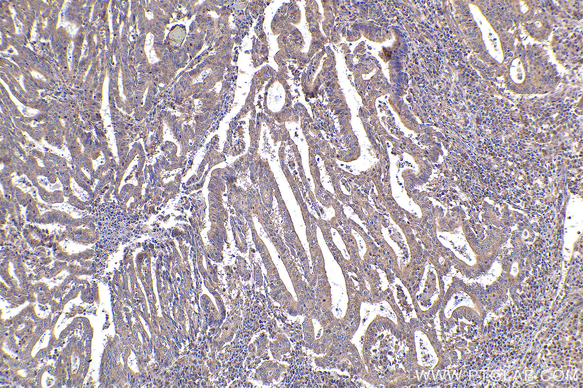 Immunohistochemical analysis of paraffin-embedded human endometrial cancer tissue slide using KHC2364 (SRPK2 IHC Kit).