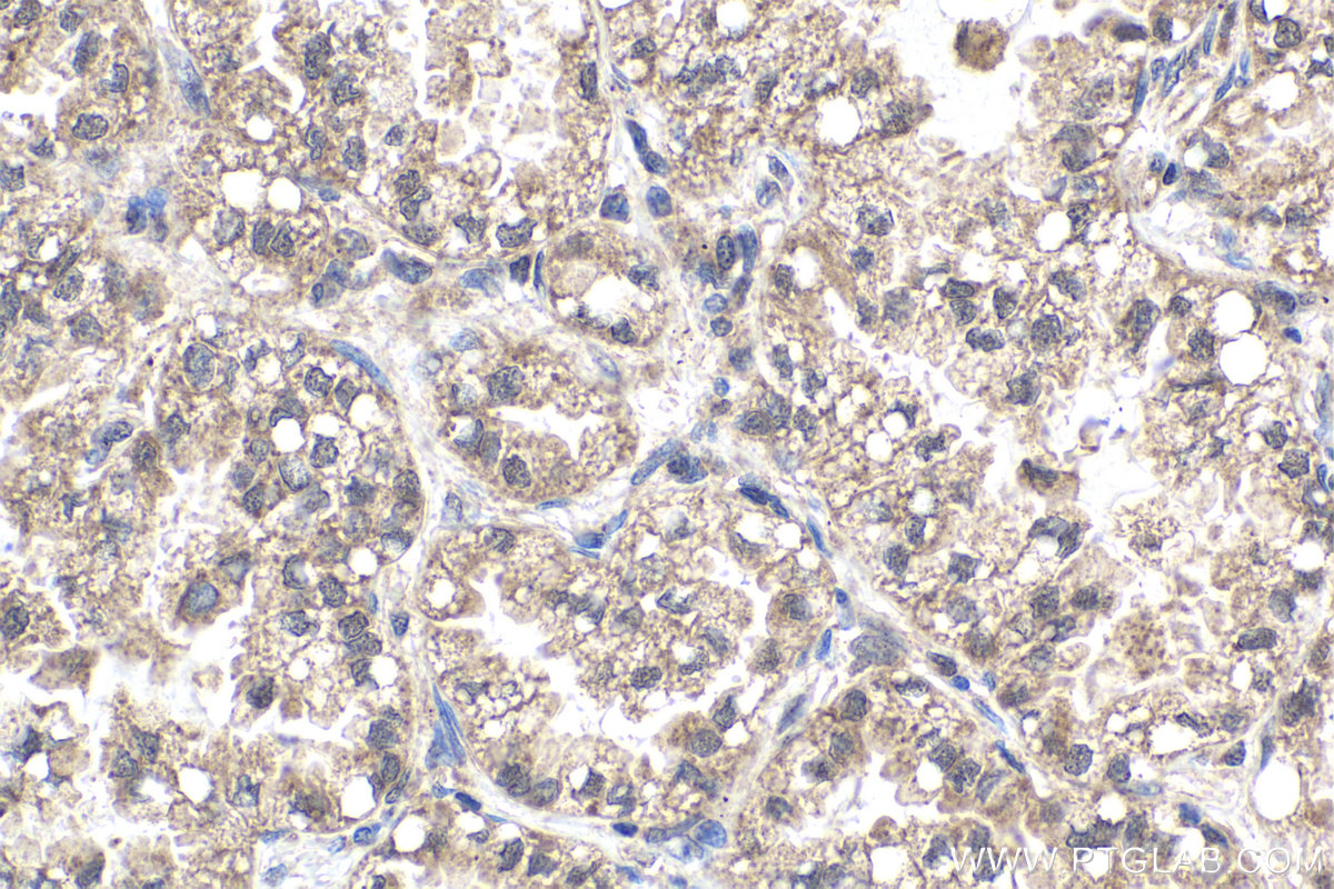 Immunohistochemical analysis of paraffin-embedded human lung cancer tissue slide using KHC1952 (SSU72 IHC Kit).
