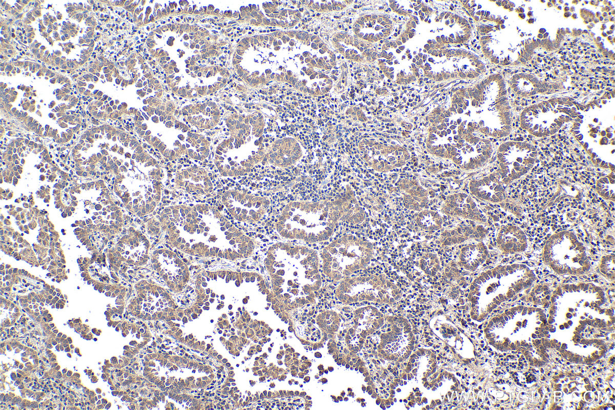 Immunohistochemical analysis of paraffin-embedded human lung cancer tissue slide using KHC1962 (STK36 IHC Kit).