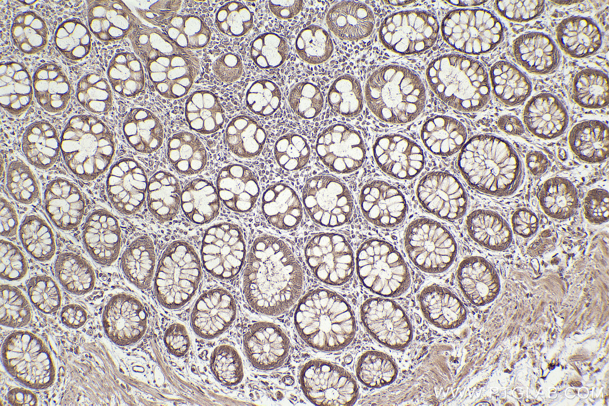 Immunohistochemical analysis of paraffin-embedded human rectal cancer tissue slide using KHC2483 (STK38 IHC Kit).