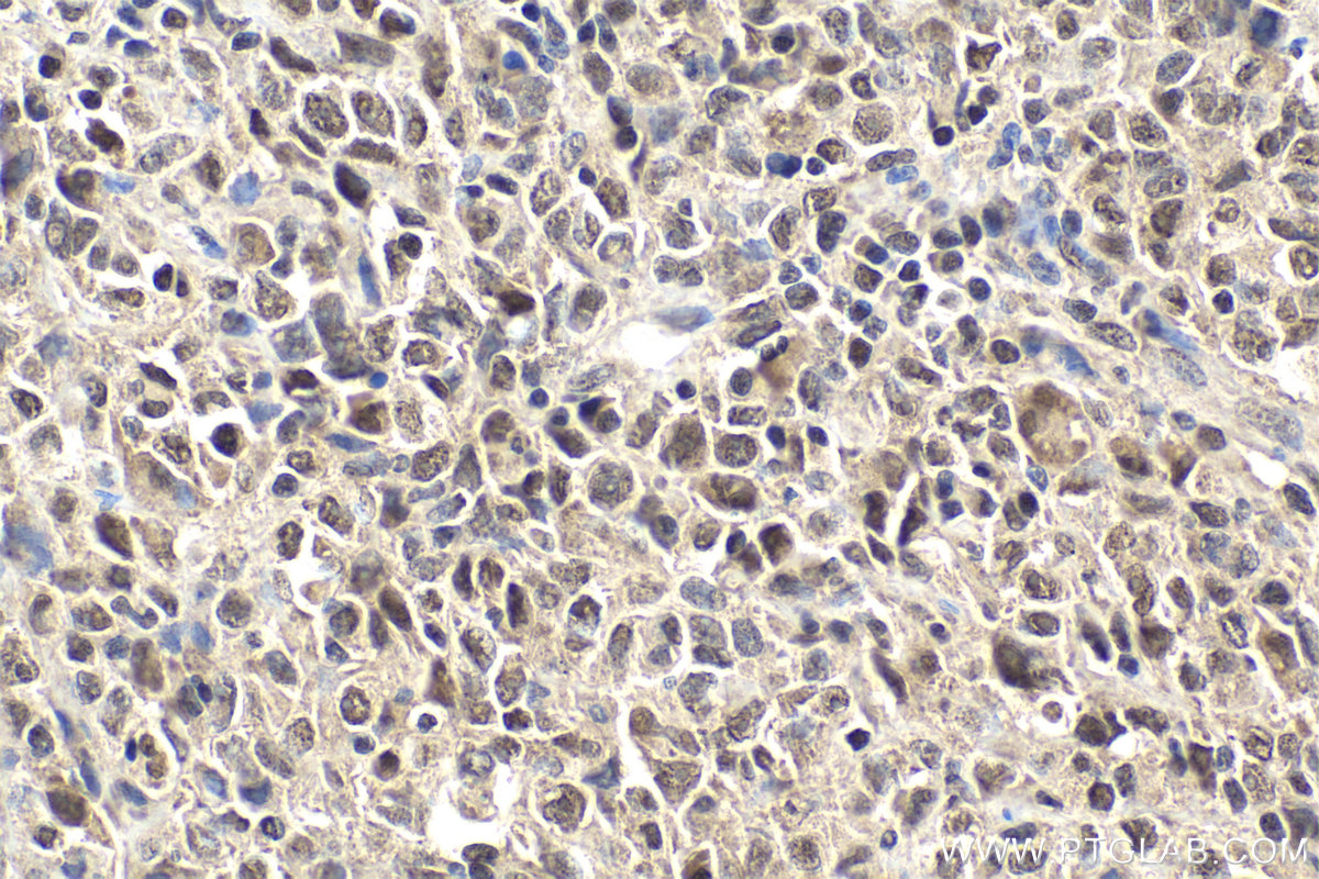 Immunohistochemical analysis of paraffin-embedded human malignant melanoma tissue slide using KHC2001 (SUFU IHC Kit).