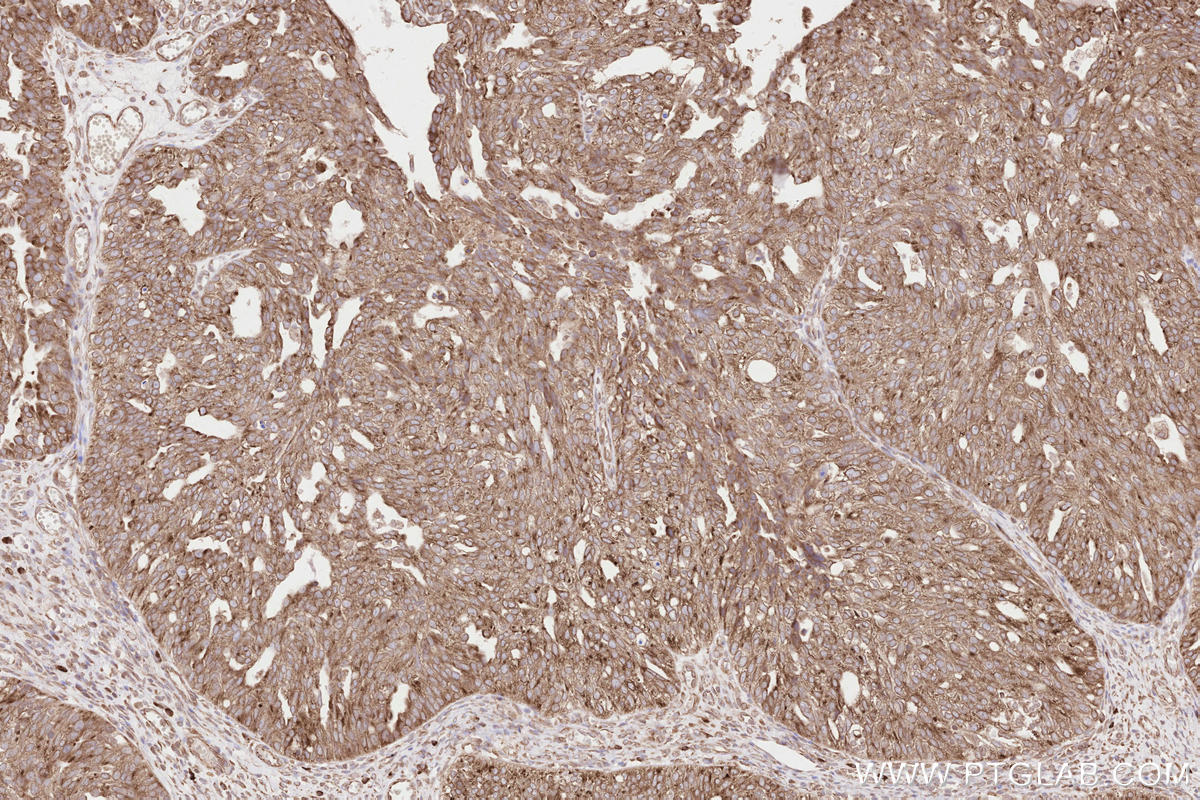 Immunohistochemical analysis of paraffin-embedded human ovary cancer tissue slide using KHC2633 (SYVN1/HRD1 IHC Kit).