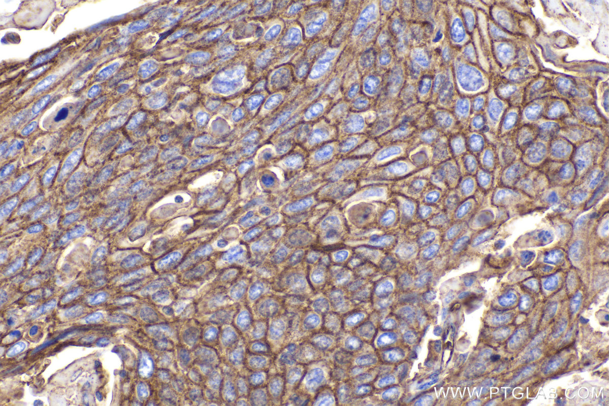 Immunohistochemical analysis of paraffin-embedded human cervical cancer tissue slide using KHC2213 (STOM IHC Kit).