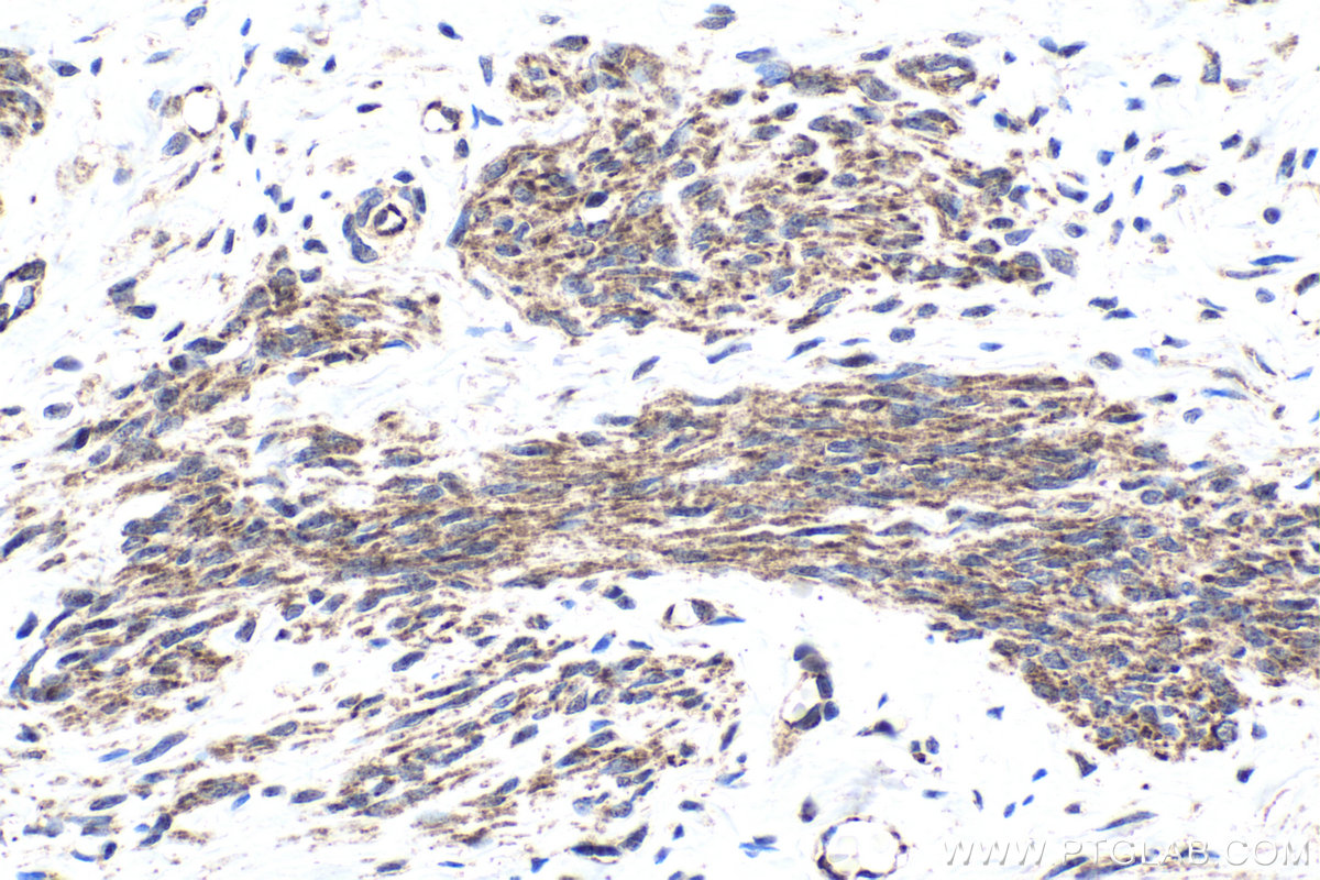 Immunohistochemical analysis of paraffin-embedded human cervical cancer tissue slide using KHC1939 (TASL/CXorf21 IHC Kit).