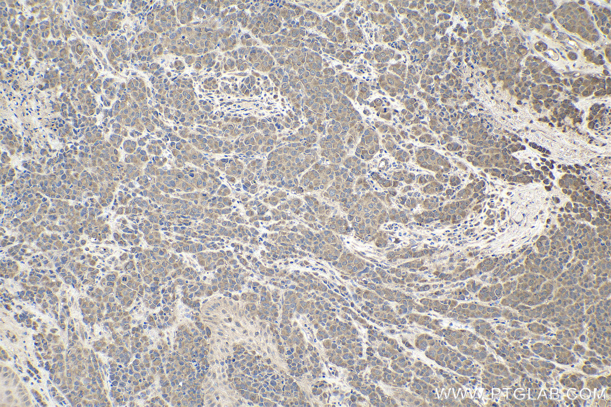 Immunohistochemical analysis of paraffin-embedded human malignant melanoma tissue slide using KHC1939 (TASL/CXorf21 IHC Kit).