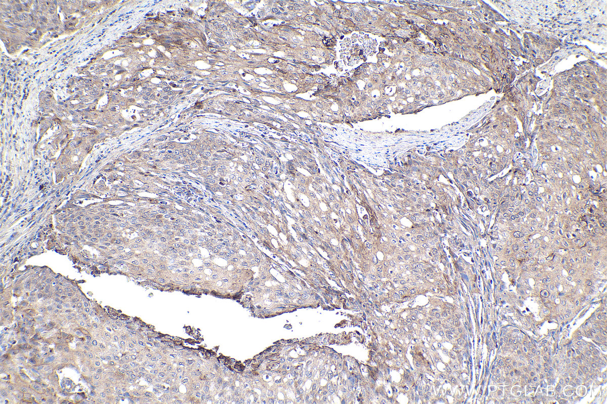 Immunohistochemical analysis of paraffin-embedded human cervical cancer tissue slide using KHC1936 (TDRD3 IHC Kit).