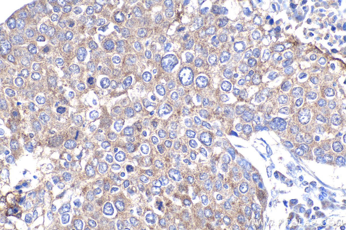 Immunohistochemical analysis of paraffin-embedded human lung cancer tissue slide using KHC1936 (TDRD3 IHC Kit).