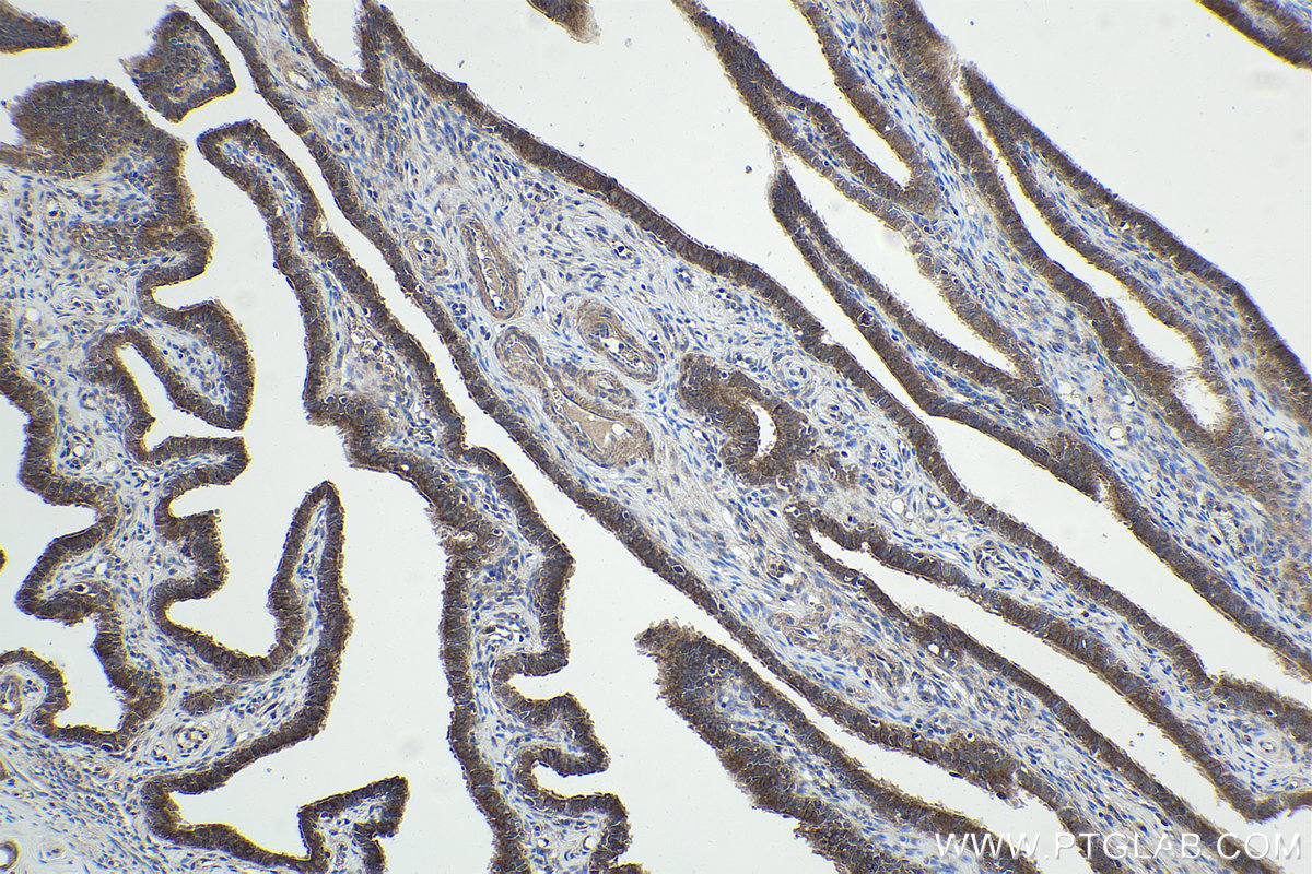 Immunohistochemical analysis of paraffin-embedded human ovary tumor tissue slide using KHC1928 (TNKS2 IHC Kit).