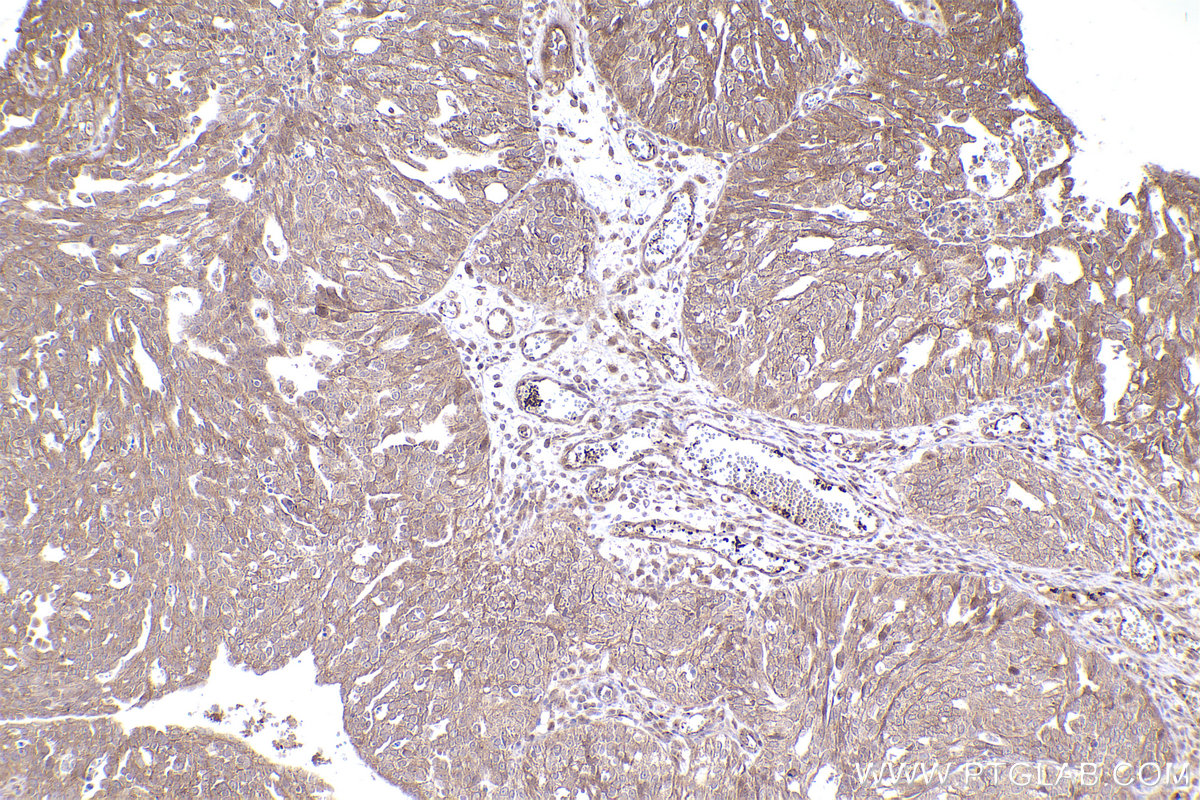 Immunohistochemical analysis of paraffin-embedded human ovary cancer tissue slide using KHC2445 (TOB2 IHC Kit).