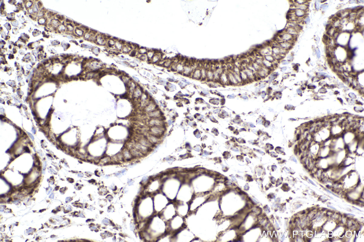 Immunohistochemical analysis of paraffin-embedded human rectal cancer tissue slide using KHC2487 (TOMM20 IHC Kit).