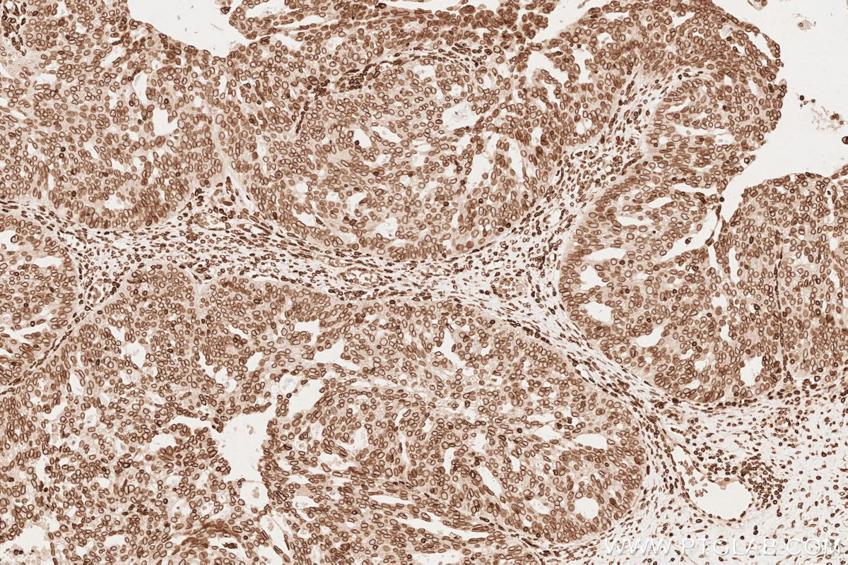 Immunohistochemical analysis of paraffin-embedded human ovary cancer tissue slide using KHC2546 (TOR1AIP1 IHC Kit).