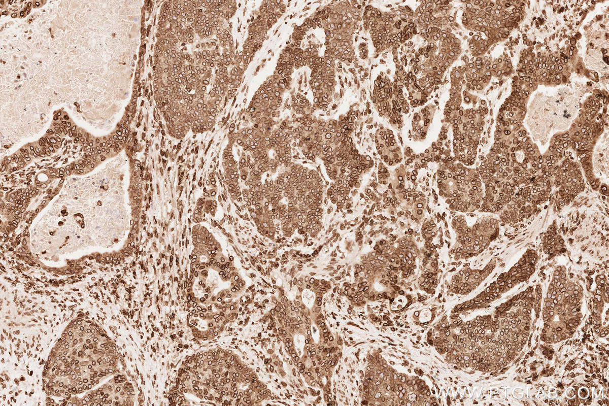 Immunohistochemical analysis of paraffin-embedded human stomach cancer tissue slide using KHC2546 (TOR1AIP1 IHC Kit).