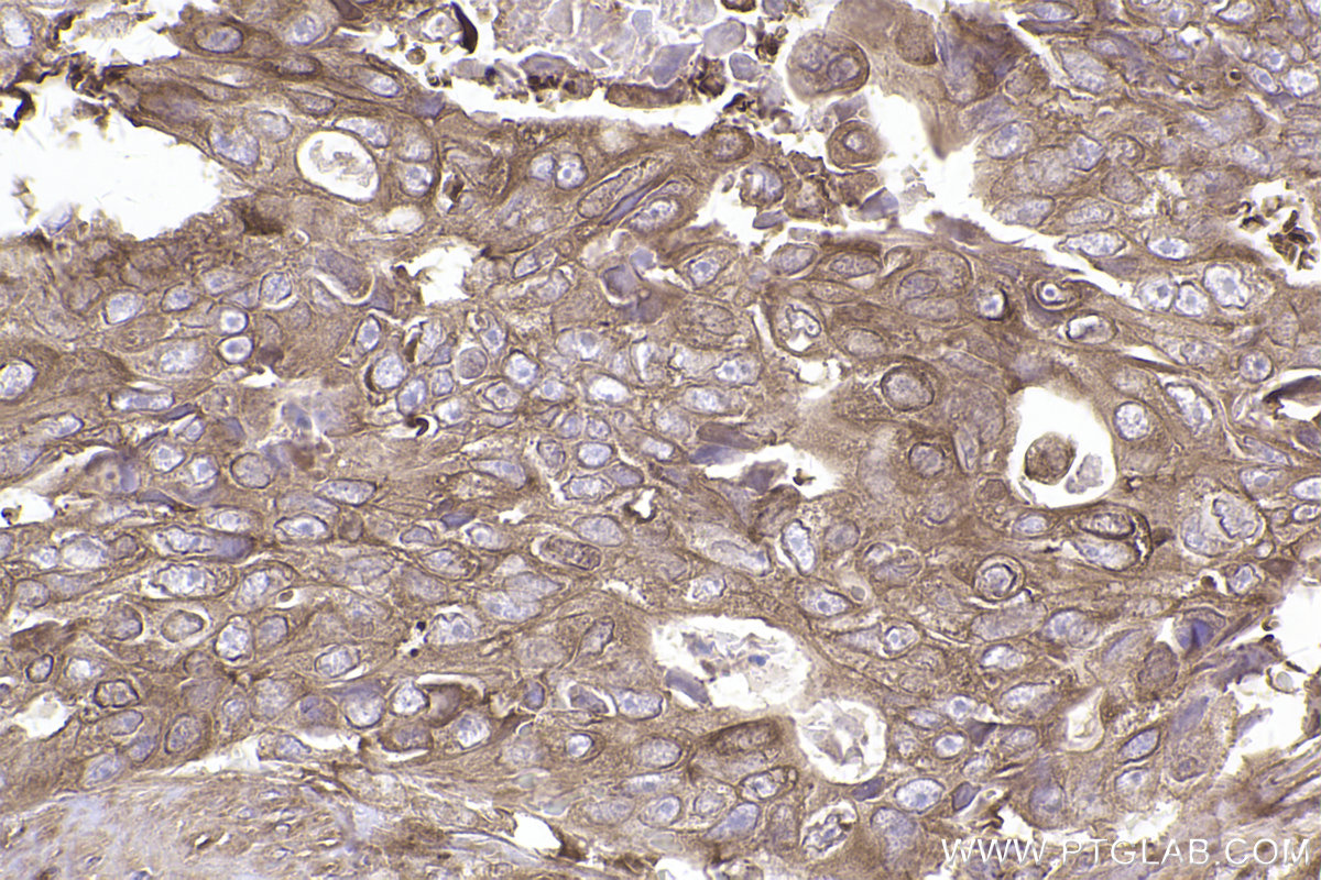 Immunohistochemical analysis of paraffin-embedded human stomach cancer tissue slide using KHC2493 (TRIP10 IHC Kit).