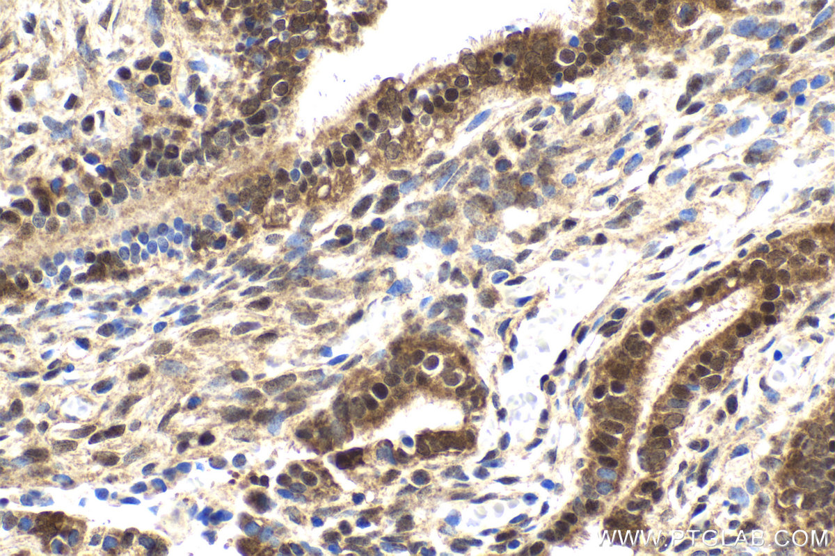 Immunohistochemical analysis of paraffin-embedded human ovary tumor tissue slide using KHC1986 (TRMT112/HSPC152 IHC Kit).