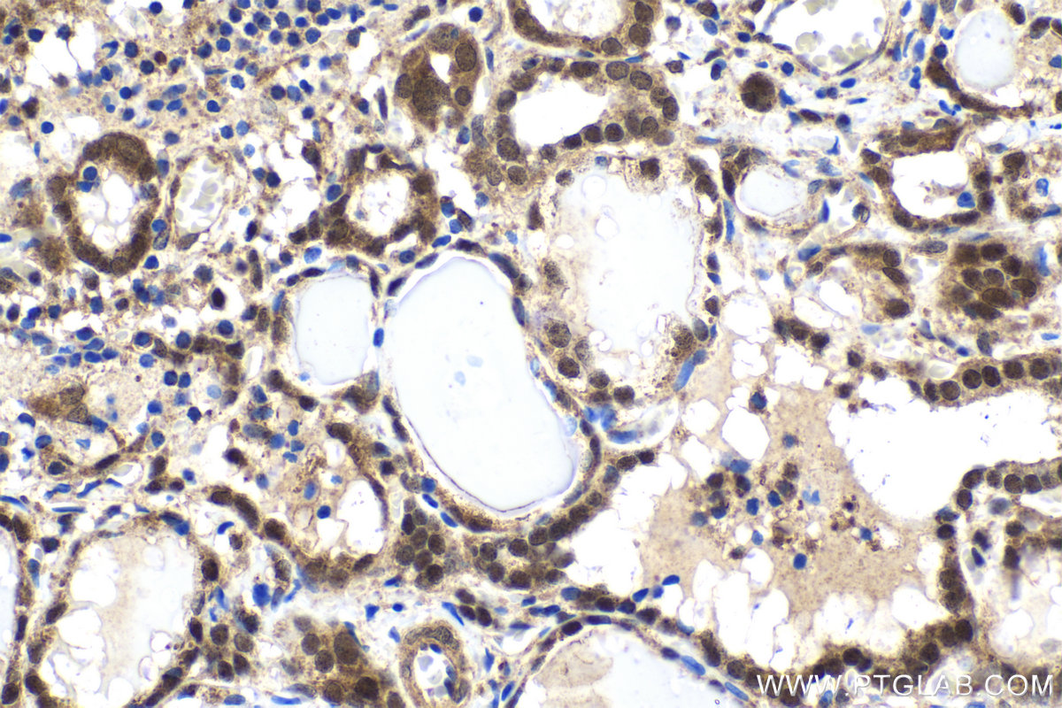 Immunohistochemical analysis of paraffin-embedded human thyroid cancer tissue slide using KHC1986 (TRMT112/HSPC152 IHC Kit).