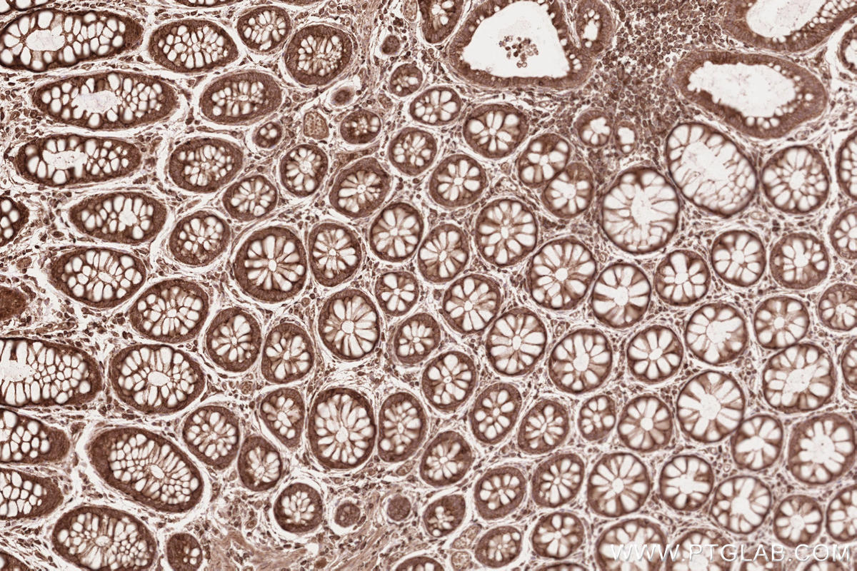 Immunohistochemical analysis of paraffin-embedded human rectal cancer tissue slide using KHC2582 (TTBK2 IHC Kit).