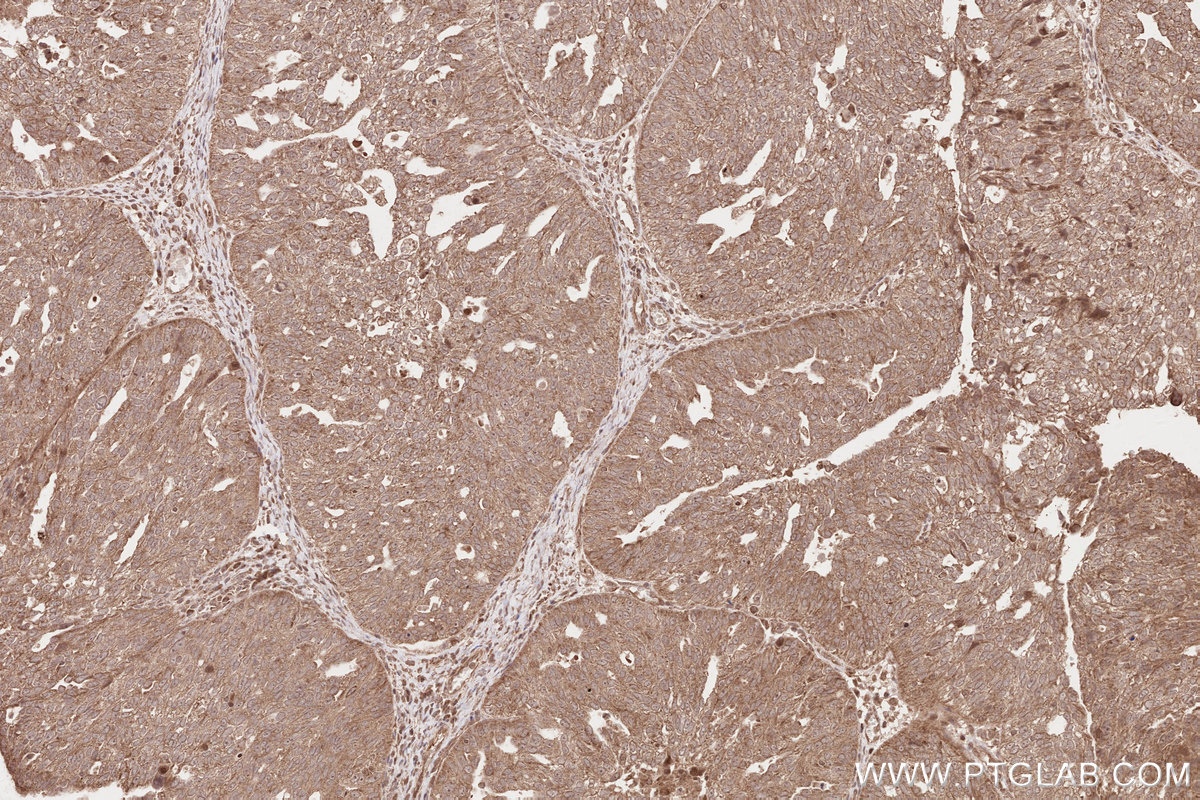 Immunohistochemical analysis of paraffin-embedded human ovary cancer tissue slide using KHC2575 (TTC19 IHC Kit).