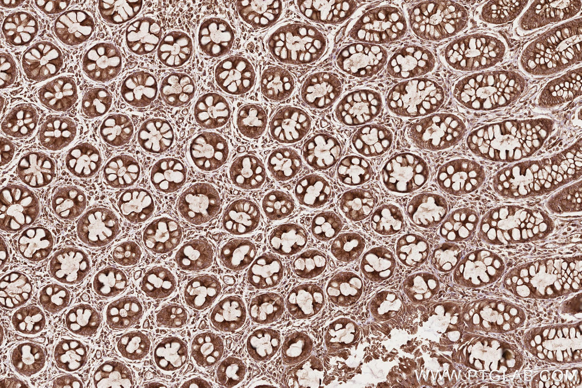 Immunohistochemical analysis of paraffin-embedded human rectal cancer tissue slide using KHC2610 (TUBA1A  IHC Kit).