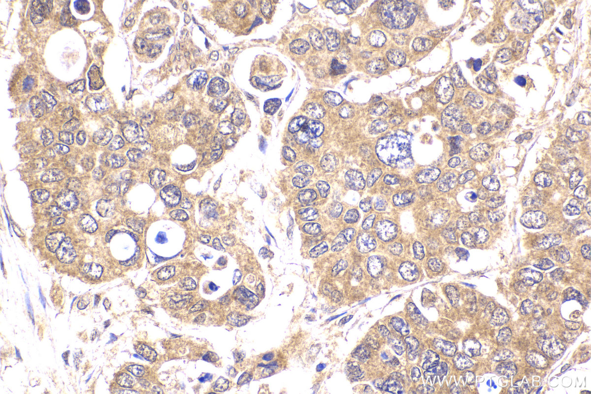 Immunohistochemical analysis of paraffin-embedded human stomach cancer tissue slide using KHC2222 (TYK2 IHC Kit).