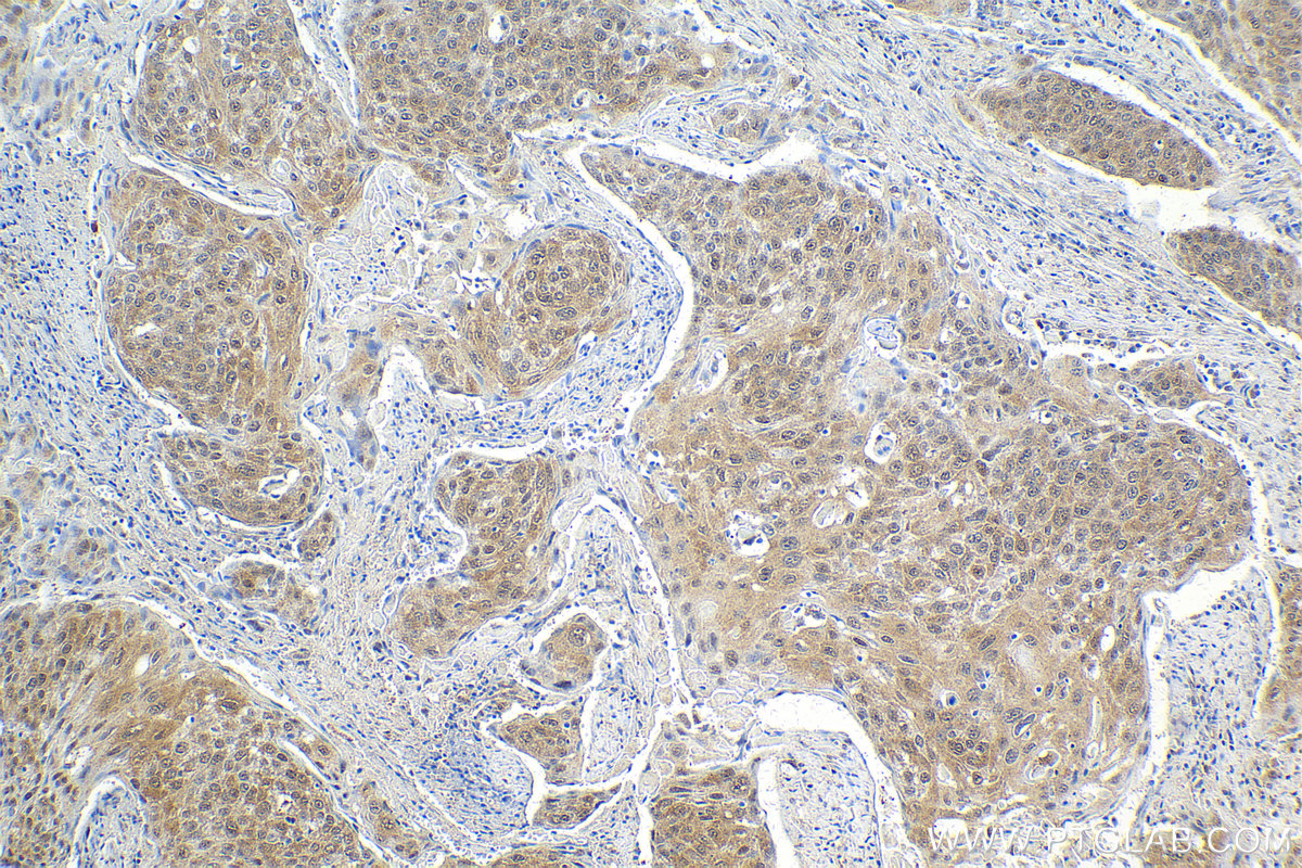 Immunohistochemical analysis of paraffin-embedded human cervical cancer tissue slide using KHC2134 (UBE4B IHC Kit).