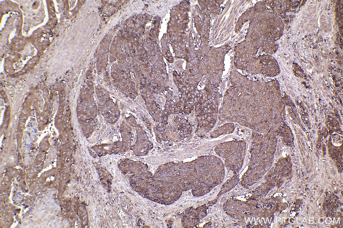 Immunohistochemical analysis of paraffin-embedded human stomach cancer tissue slide using KHC2554 (UBR4 IHC Kit).