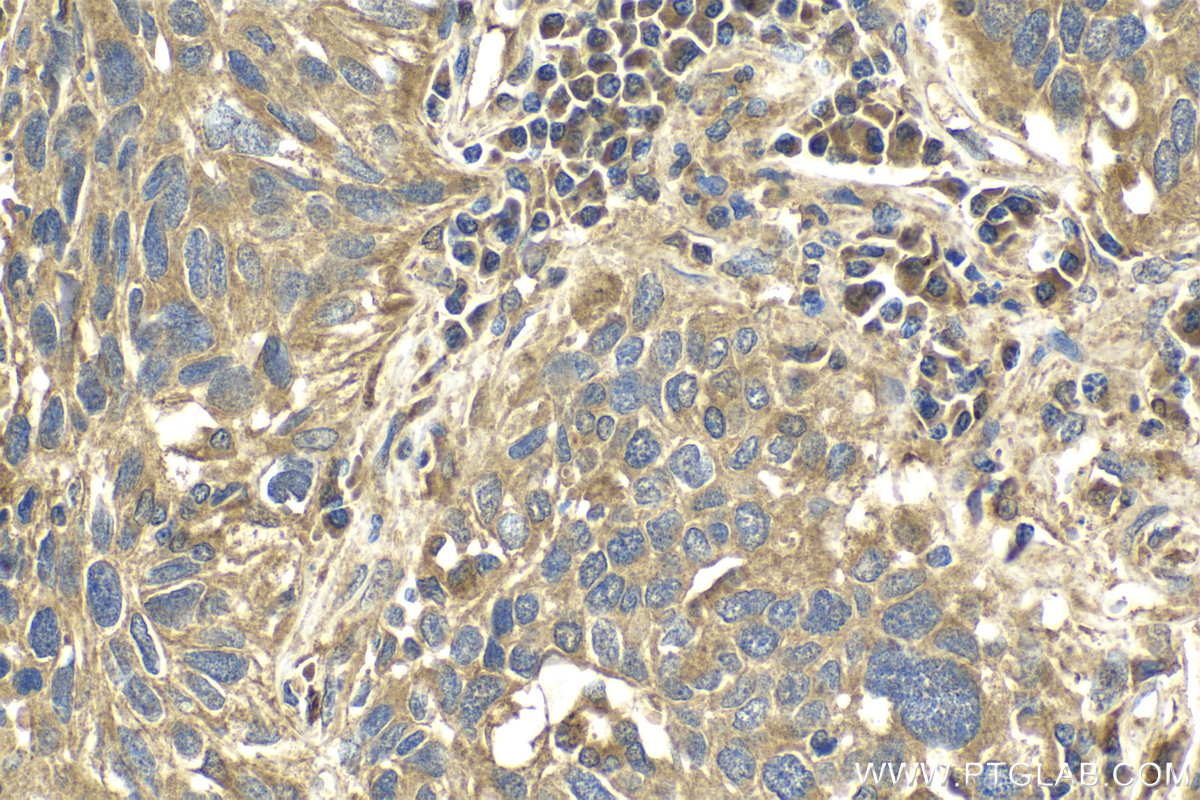 Immunohistochemical analysis of paraffin-embedded human lung cancer tissue slide using KHC2111 (ULK1 IHC Kit).