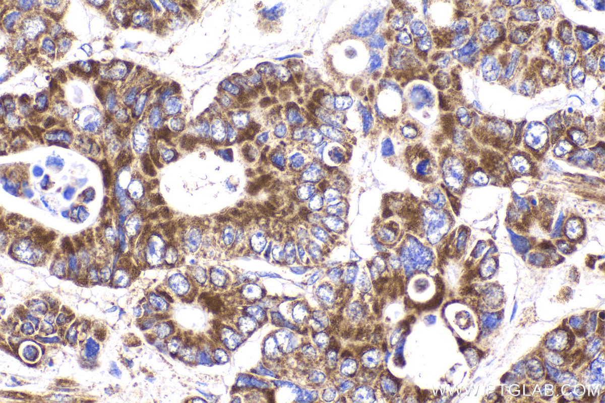 Immunohistochemical analysis of paraffin-embedded human stomach cancer tissue slide using KHC2165 (UQCRH IHC Kit).