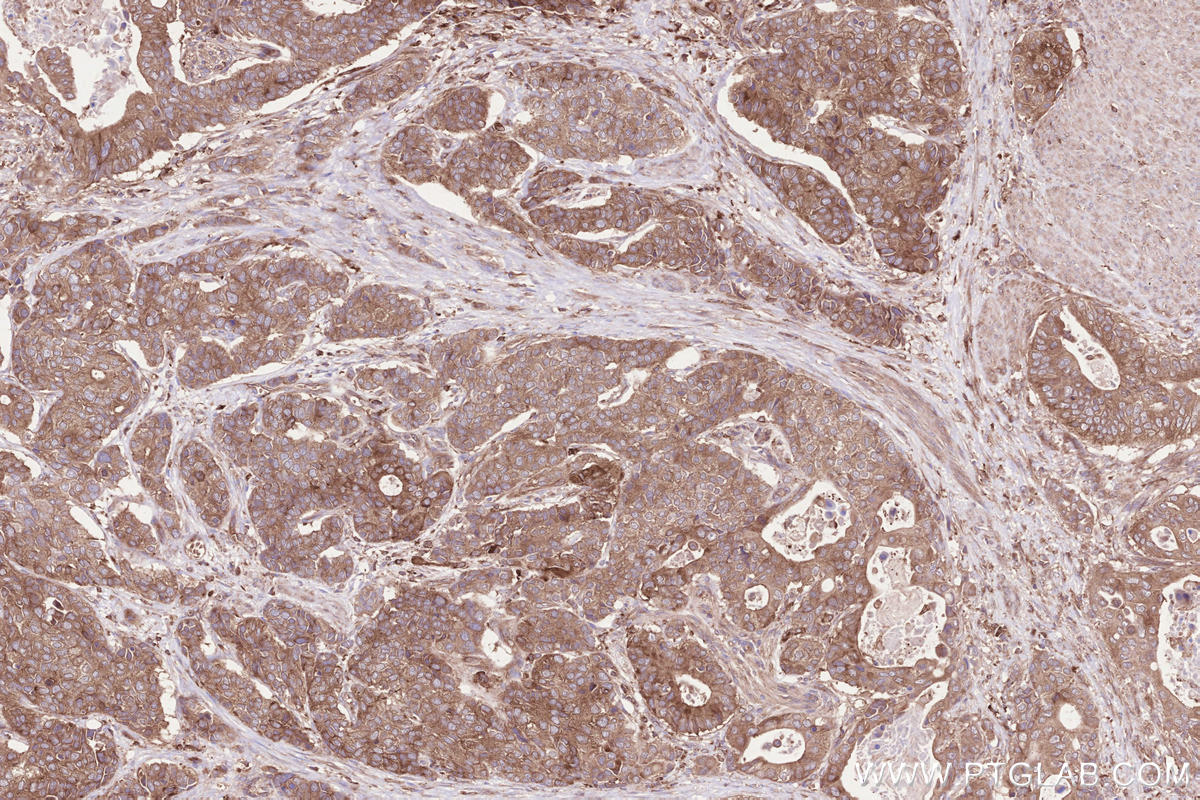 Immunohistochemical analysis of paraffin-embedded human stomach cancer tissue slide using KHC2560 (VPS53 IHC Kit).