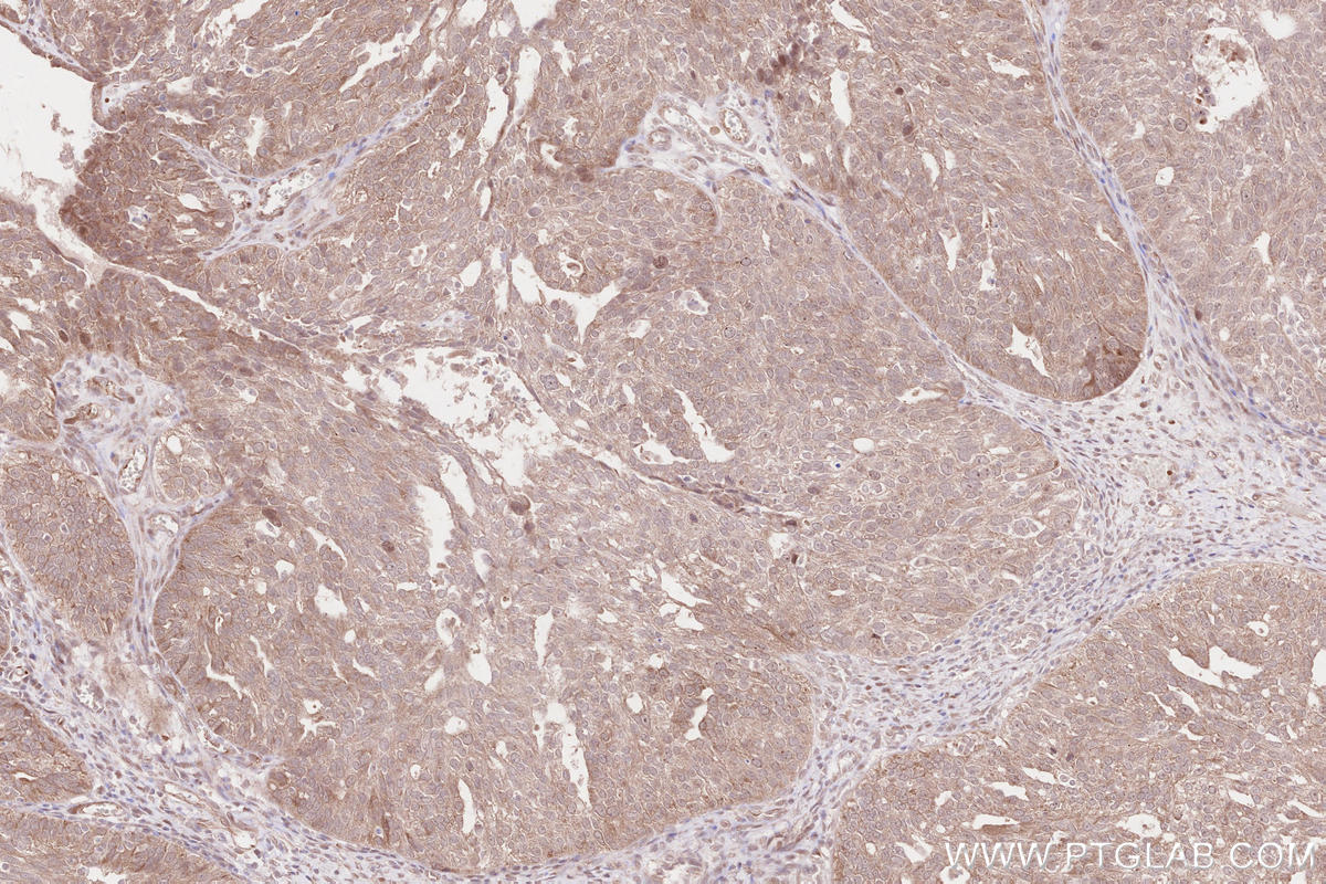 Immunohistochemical analysis of paraffin-embedded human ovary cancer tissue slide using KHC2578 (WBP2NL IHC Kit).