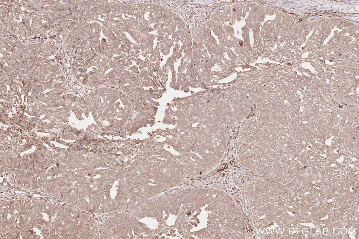 Immunohistochemical analysis of paraffin-embedded human ovary cancer tissue slide using KHC2537 (WDR81 IHC Kit).