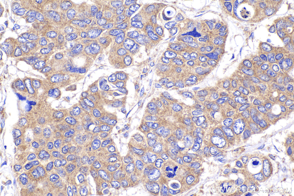 Immunohistochemical analysis of paraffin-embedded human stomach cancer tissue slide using KHC2166 (YES1 IHC Kit).