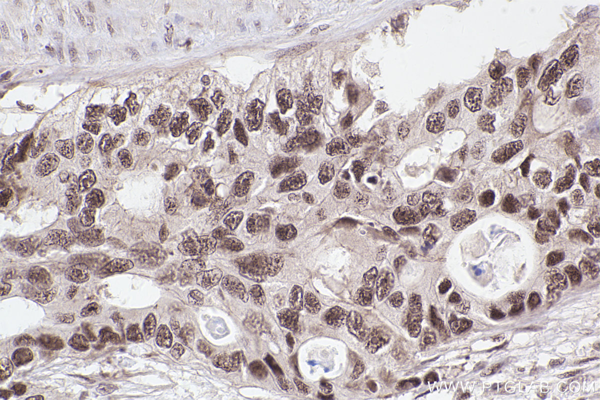 Immunohistochemical analysis of paraffin-embedded human stomach cancer tissue slide using KHC2550 (ZC3H13 IHC Kit).