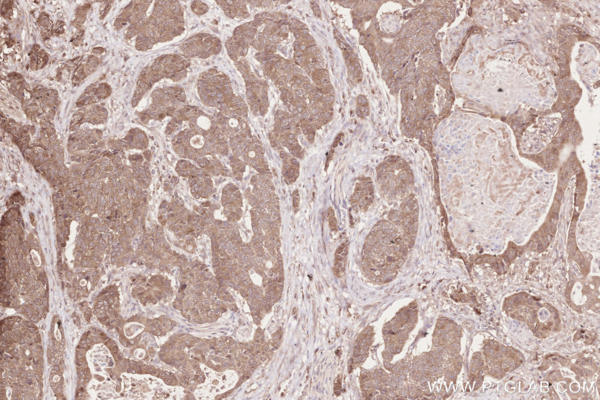 Immunohistochemical analysis of paraffin-embedded human stomach cancer tissue slide using KHC2618 (ZC3HAV1 IHC Kit).